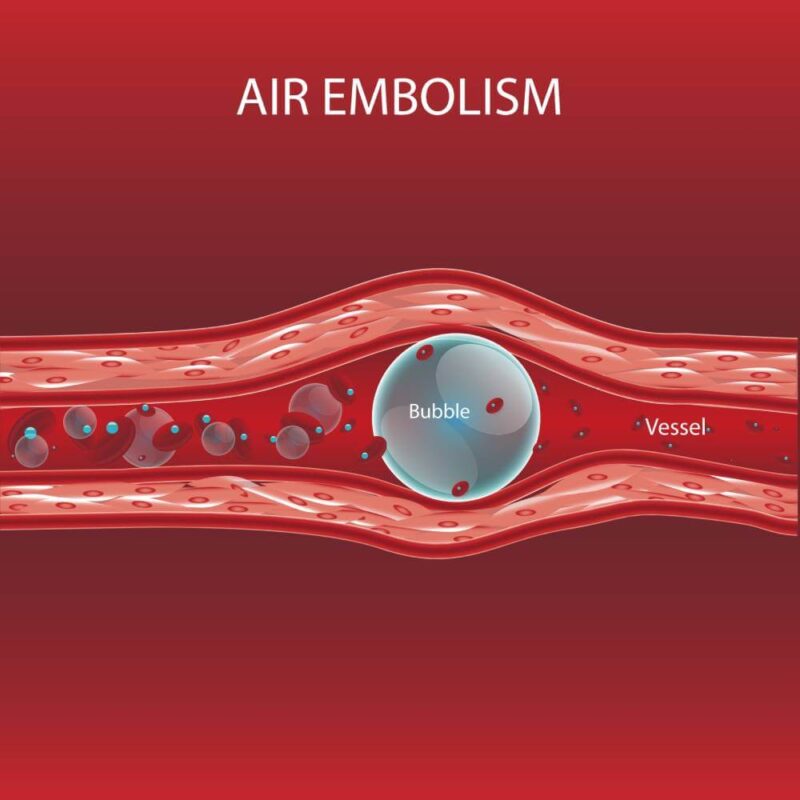 Thủ Dâm Bằng Vòi Nước: Tất Cả Về Lợi Ích, Rủi Ro & Hướng Dẫn An Toàn 9 air embolism