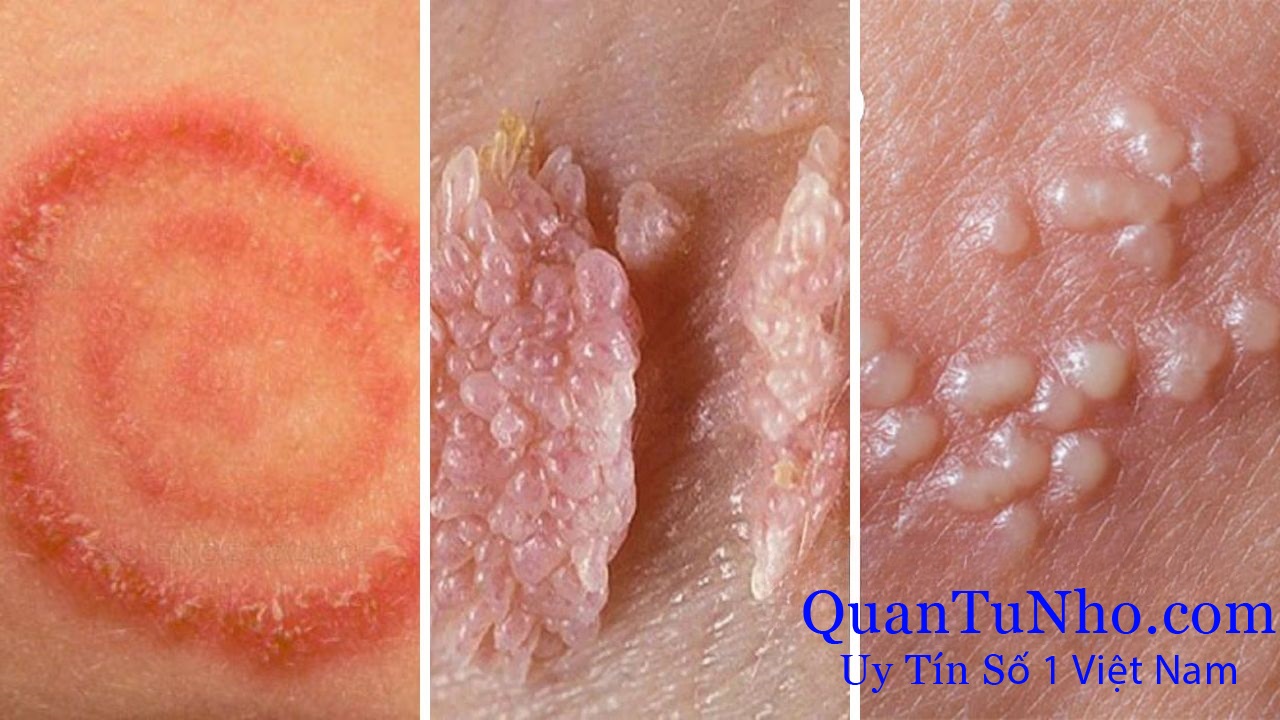 Quan hệ nhiều người tiềm ẩn nhiều rủi ro nhiễm các bệnh về tình dục