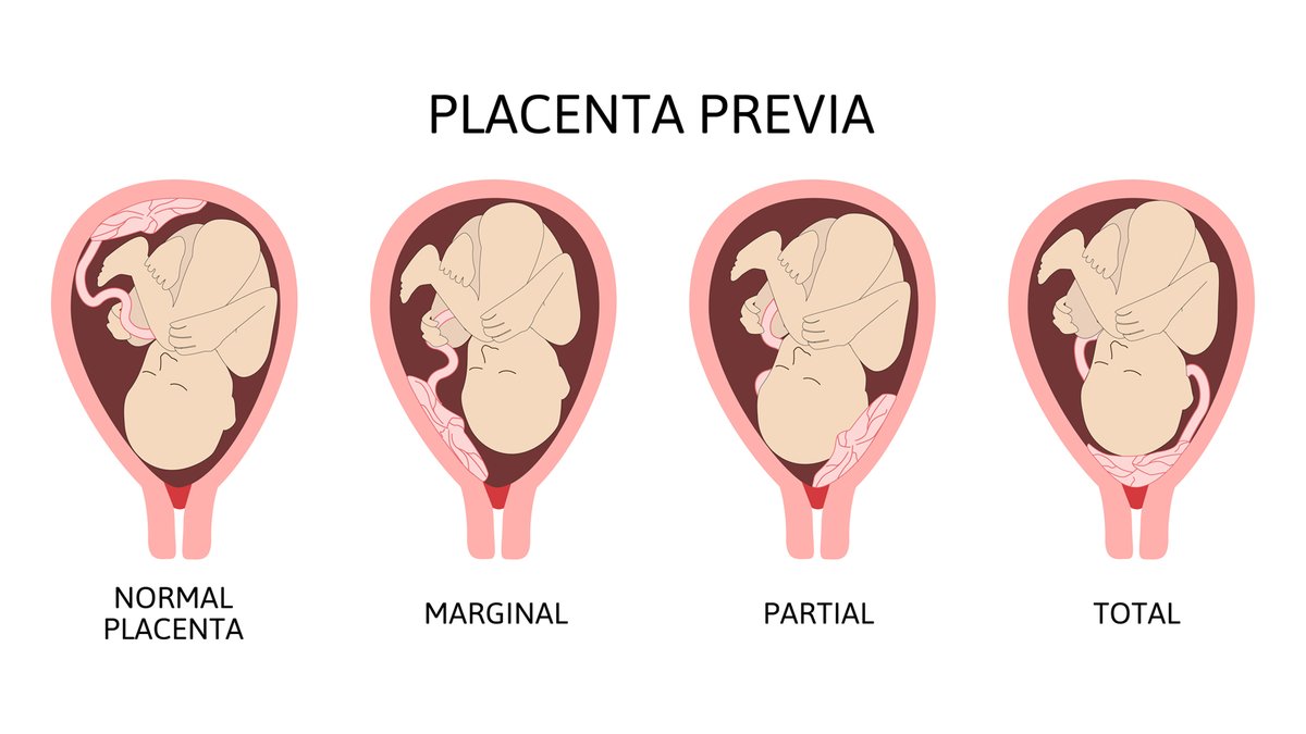 Bầu 6 tháng quan hệ được không: Lợi ích, Rủi ro, Tư thế an toàn và Lưu ý y khoa 4 Placenta Previa