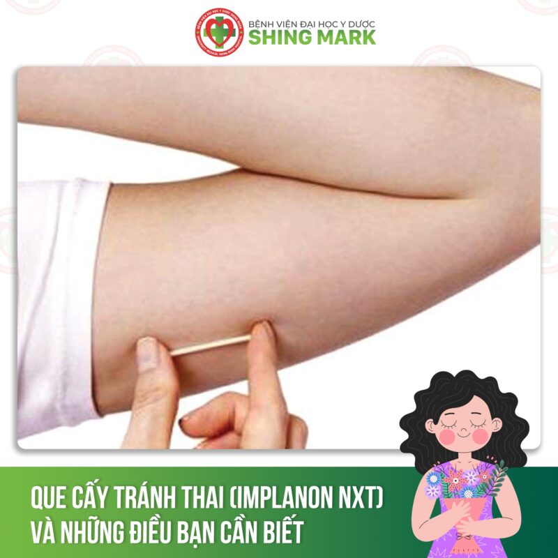 cấy que ngừa thai có ngăn chặn được kinh nguyệt