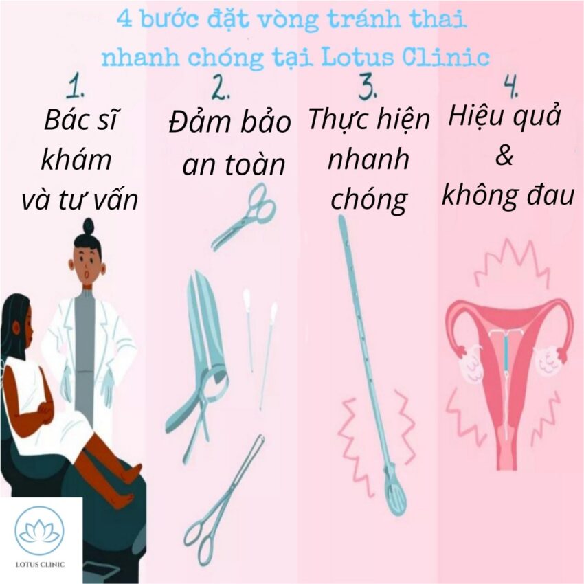 Quy trình đặt vòng