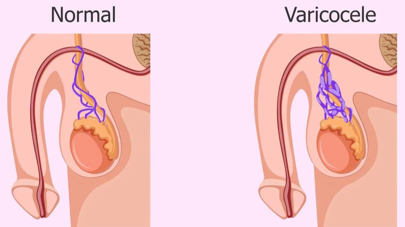 Giãn tĩnh mạch thừng tinh (Varicocele)