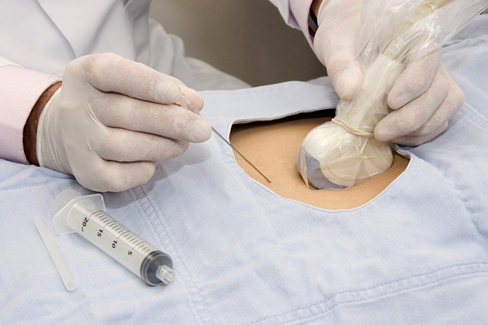 Dấu hiệu mang thai bé trai: Thông tin, Phân loại, Mức độ tin cậy và Cách nhận biết 9 chọc ối