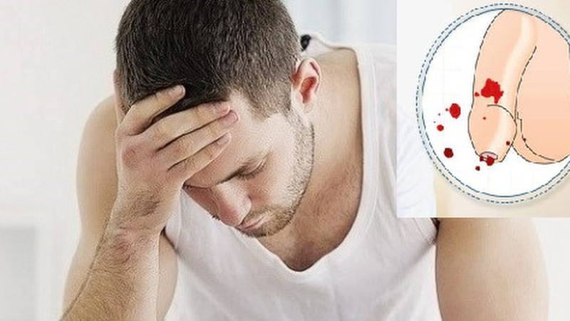 Biểu hiện của con trai khi quan hệ lần đầu: Thông tin, Phân loại, Nguyên nhân và Giải pháp 7 Cậu nhỏ" có chảy máu trong lần đầu quan hệ không?