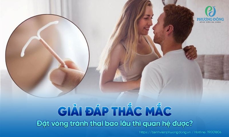 đặt vòng tránh thai kiêng quan hệ bao lâu