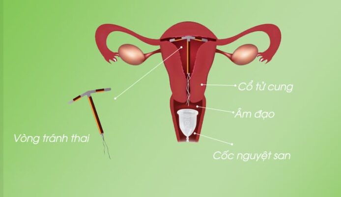 Đặt Vòng Tránh Thai Có Dùng Được Cốc Nguyệt San Không