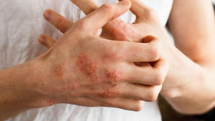 Dị ứng bao cao su: Nguyên nhân, Triệu chứng, Chẩn đoán và Cách điều trị 1 Dị ứng bao cao su