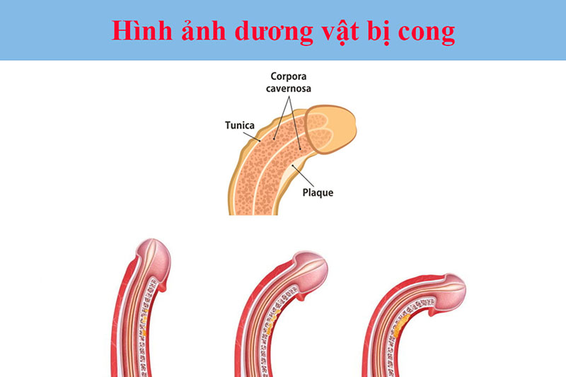 dương vật cong xuống
