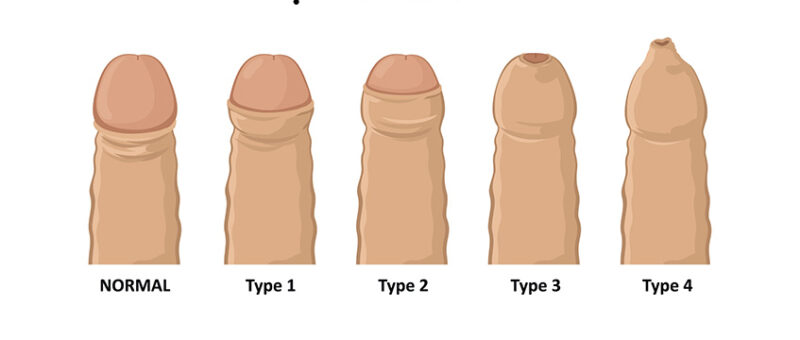 hep bao quy dau o nam gioi e1761118354677