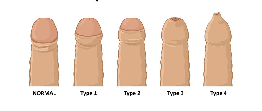 hep bao quy dau o nam gioi e1761118354677