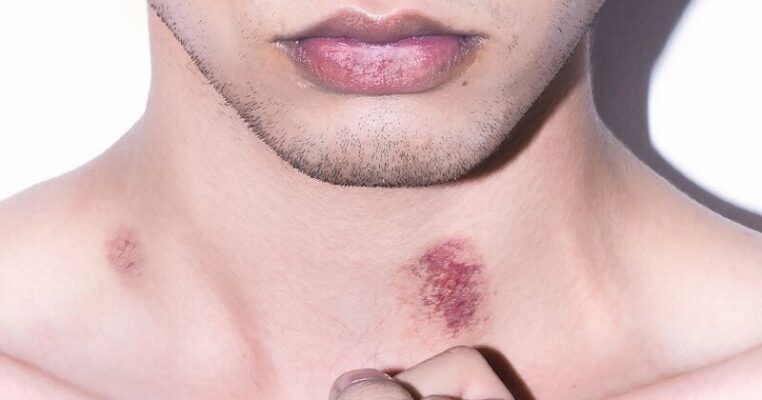 hickey