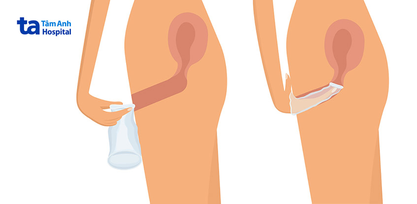 cách sử dụng bao cao su nữ