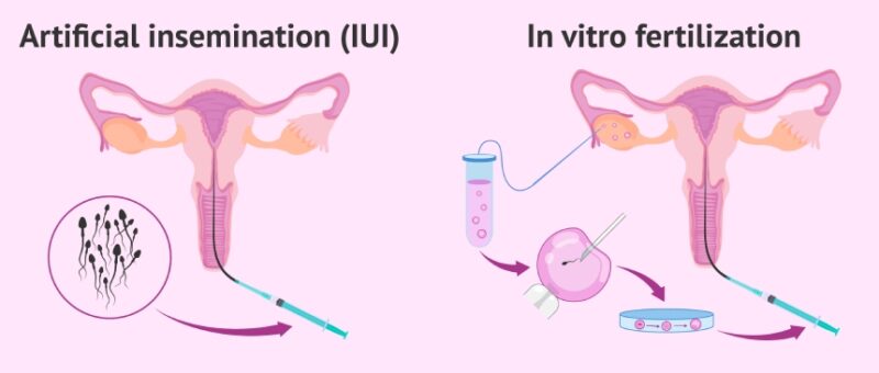 Liệu pháp hỗ trợ thụ tinh: IUI, IVF