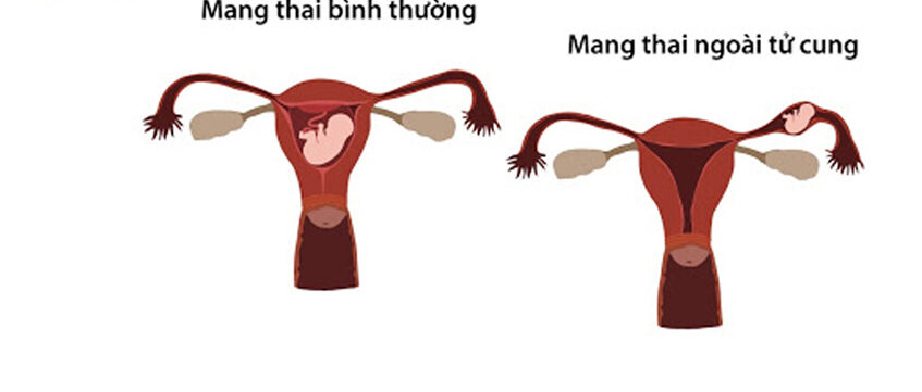 thai ngoài tử cung
