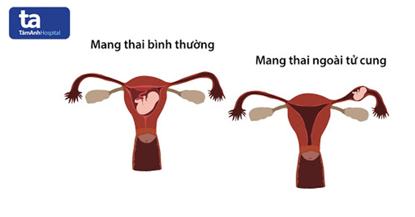 thai ngoài tử cung