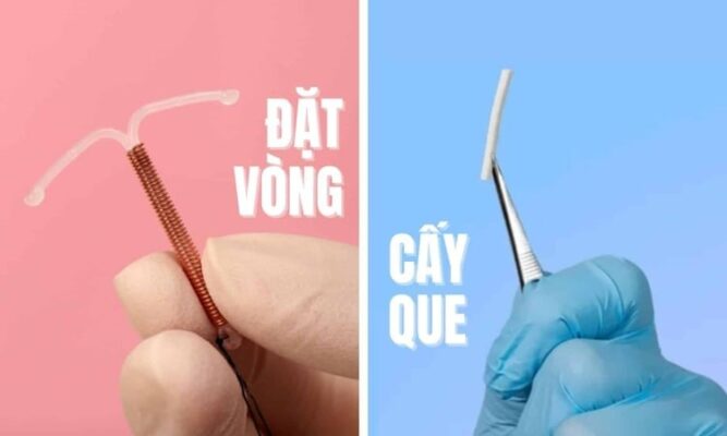nên đặt vòng hay cấy que tránh thai