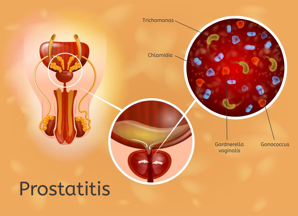 prostatitis