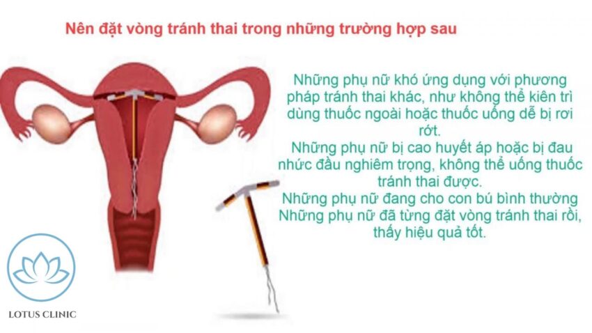 Khi nào cần đặt vòng tránh thai