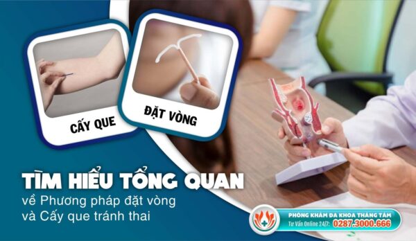 nên đặt vòng hay cấy que tránh thai