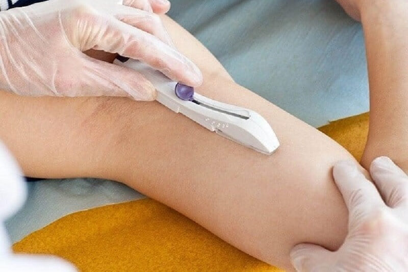 Tác dụng phụ của cấy que tránh thai