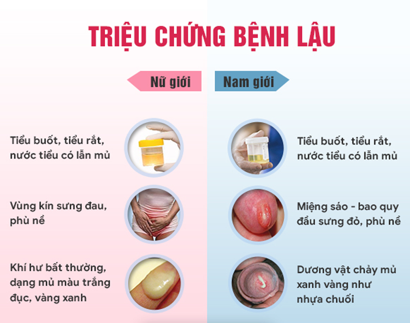 Triệu chứng điển hình của bệnh lậu