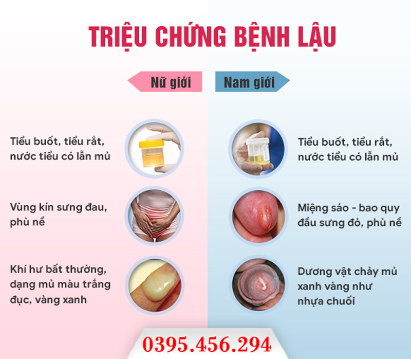 Triệu chứng điển hình của bệnh lậu