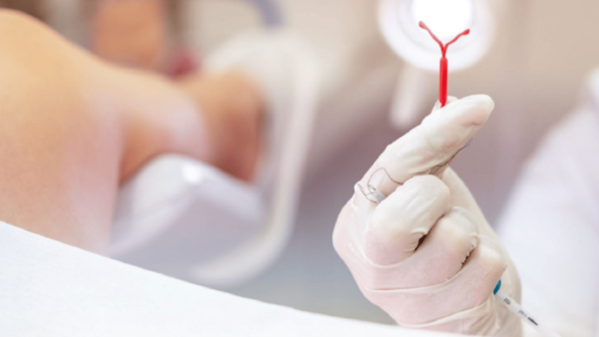 Vòng tránh thai chữ T: Thông tin, Cơ chế, Hiệu quả và Quy trình 4 Tuột Vòng Tránh Thai Có Sao Không