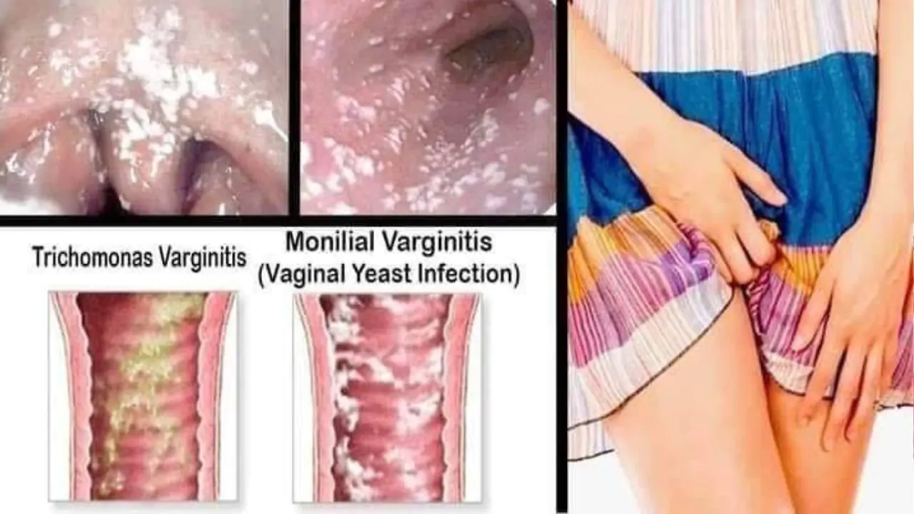 Viên đặt Gynecon: Thông tin, Thành phần, Công dụng và Hướng dẫn sử dụng 2 viem am dao do nam candida 4