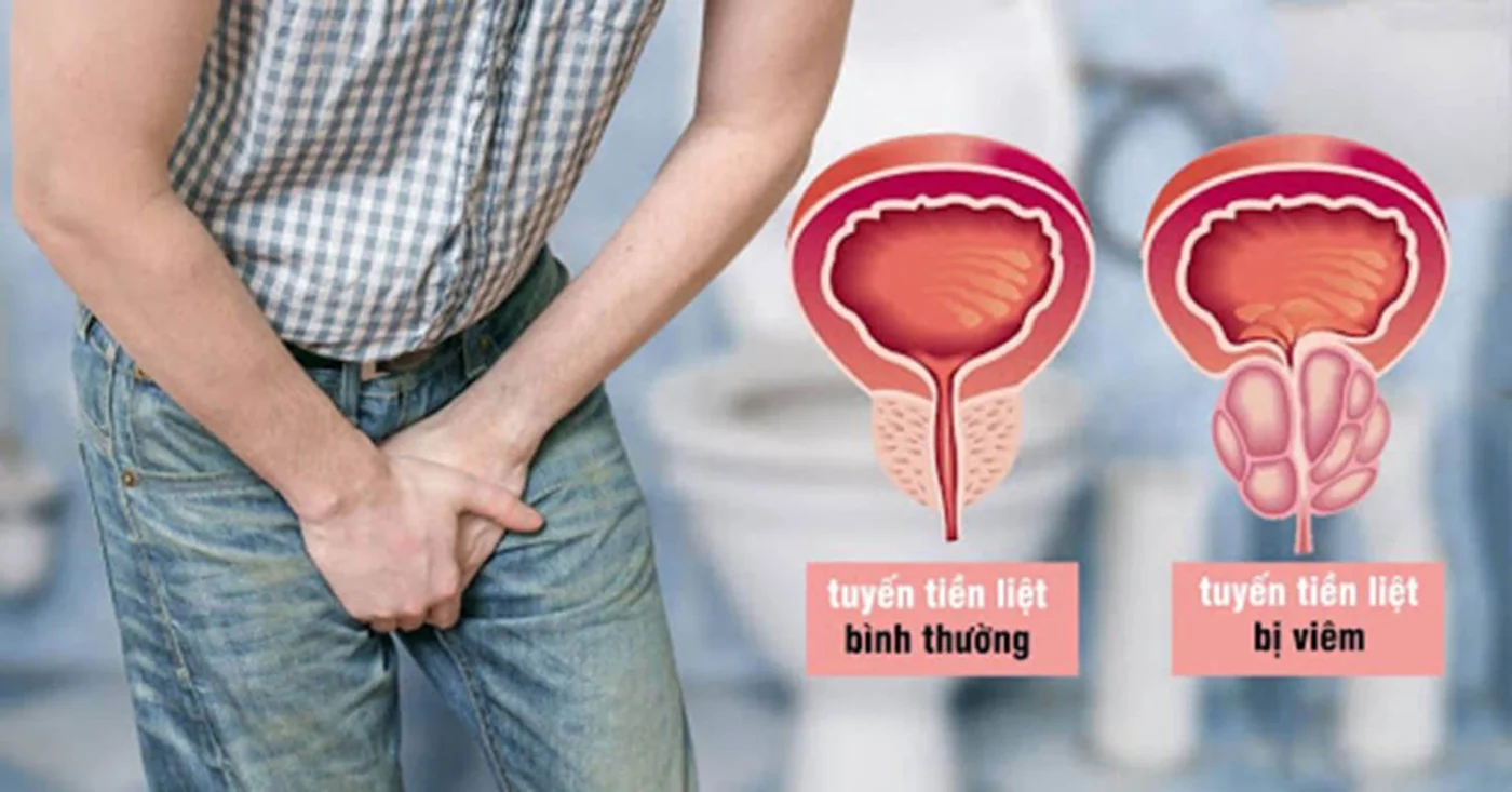 Mộng Tinh Nhiều Có Sao Không: Nguyên Nhân, Ảnh Hưởng và Cách Điều Trị 5 viêm tuyến tiền liệt