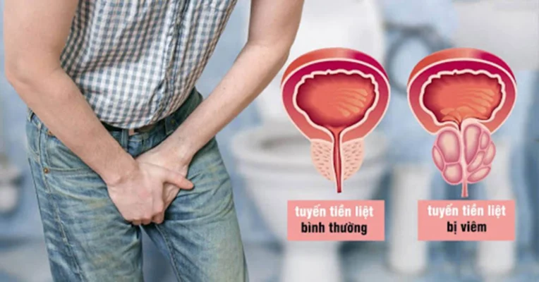 viem tuyen tien liet