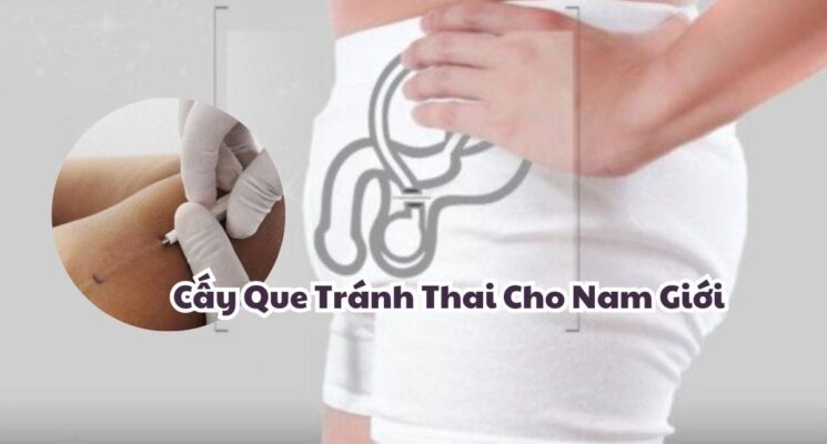 cấy que tránh thai cho nam giới