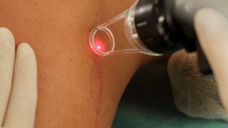Điều trị bằng Laser CO2