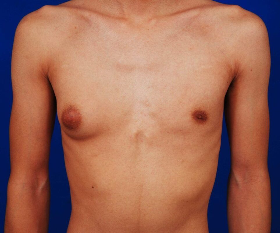Gynecomastia