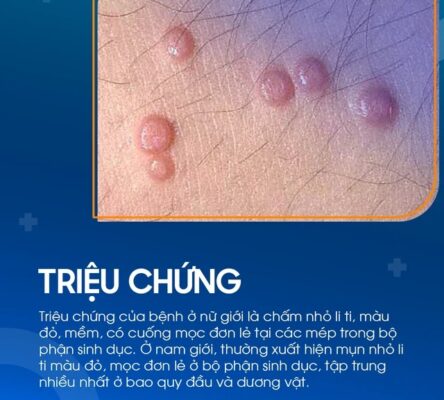 Chẩn Đoán Mắc Bệnh