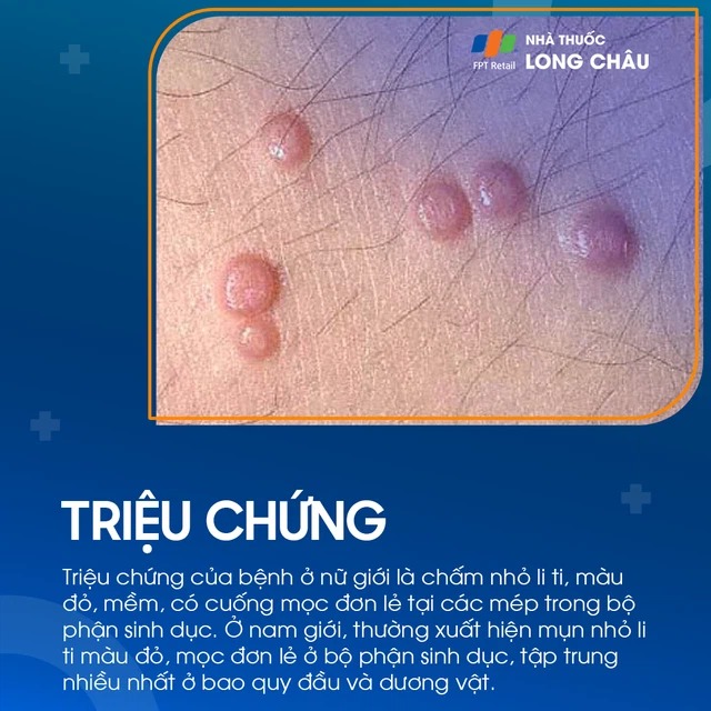 Chẩn Đoán Mắc Bệnh