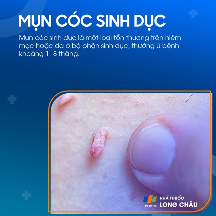 mụn cóc sinh dục ở nam
