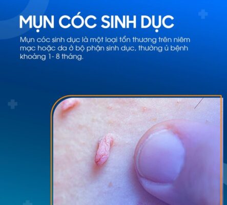 mụn cóc sinh dục ở nam