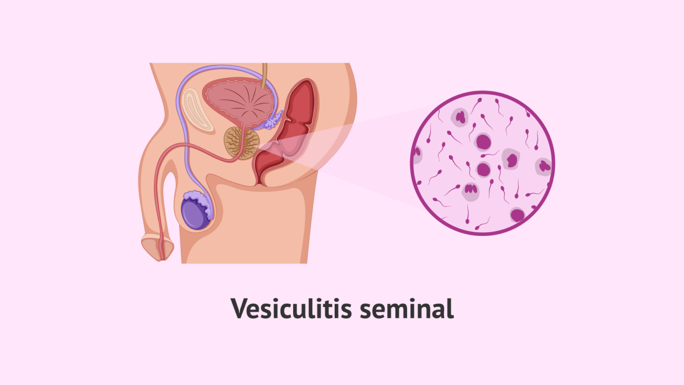 Seminal vesiculitis