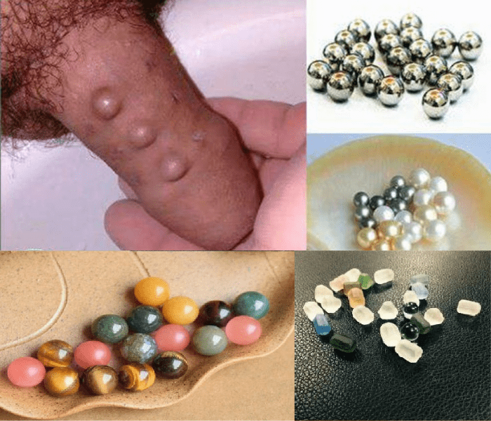 Tác Hại Của Gắn Bi: Rủi Ro, Biến Chứng, Ảnh Hưởng và Lời Khuyên Y Khoa 1 Tác Hại Của Gắn Bi