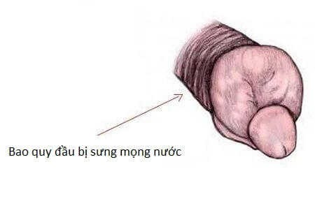bao quy đầu bị sưng mọng nước