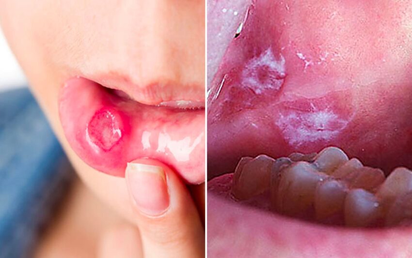 Dấu Hiệu Sùi Mào Gà Ở Nữ