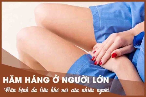 bị hăm ở người lớn