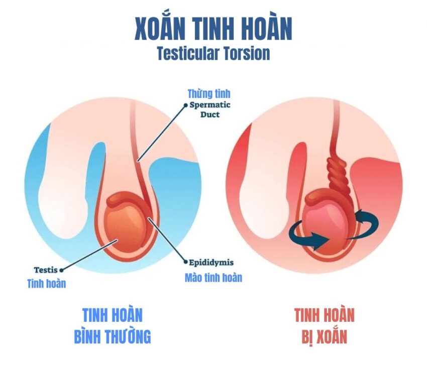 Bệnh Lý Về Tinh Hoàn
