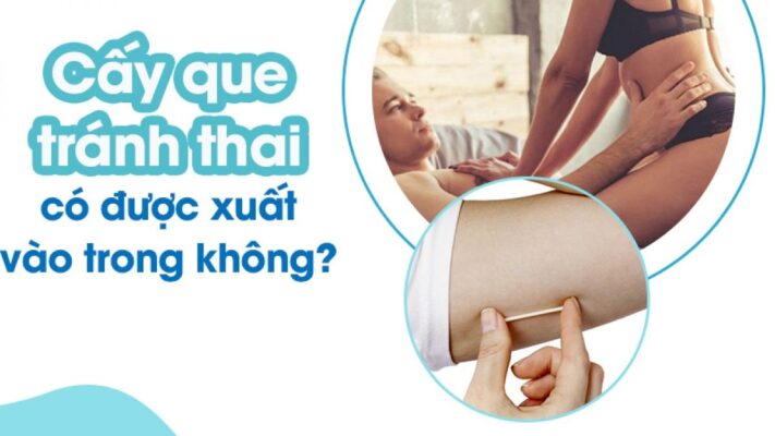cấy que tránh thai có được xuất vào trong không