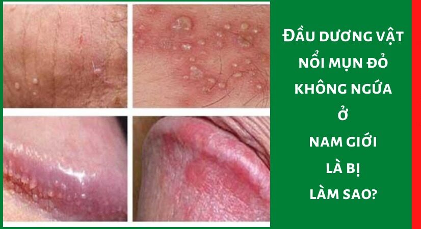 Cảnh Giác Với Các Bệnh Lây Truyền Qua Đường Tình Dục