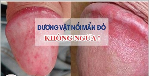 Viêm Bao Quy Đầu Do Vệ Sinh