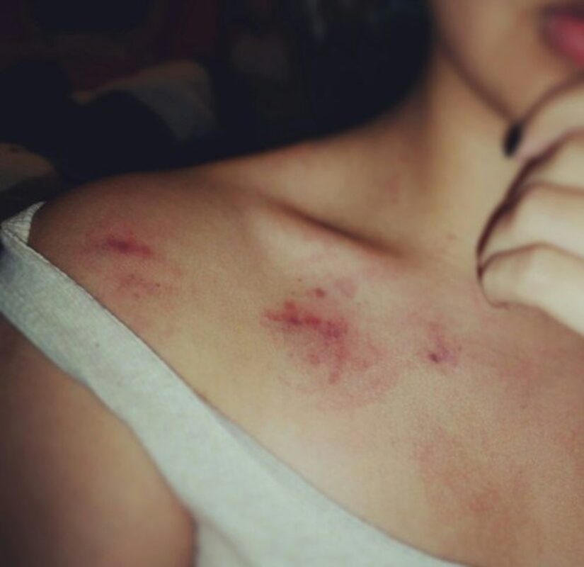 Ý Nghĩa Của Dấu Hickey Trong Tình Yêu