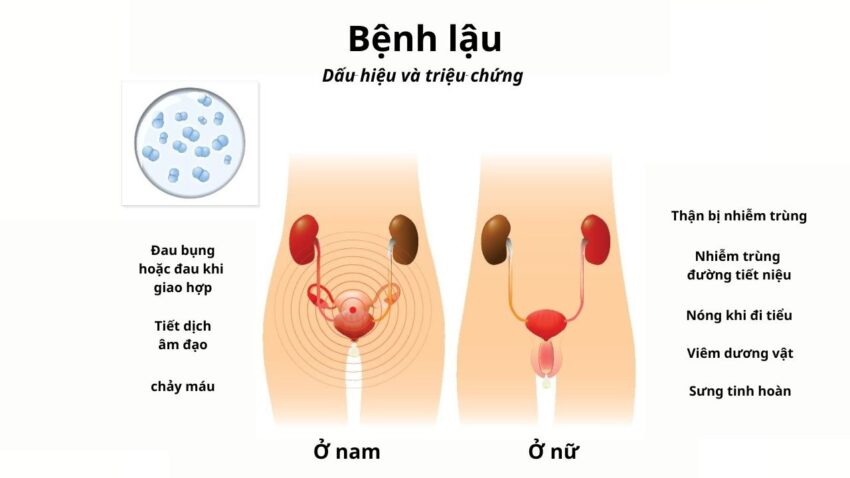 Bệnh Lậu