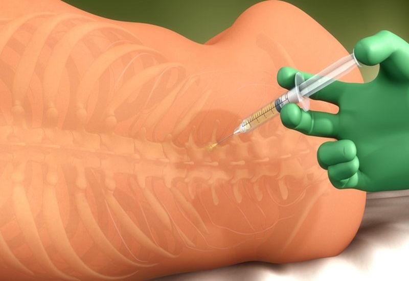 Chi phí thắt ống dẫn trứng khi sinh mổ: Phân tích, Yếu tố ảnh hưởng, Lợi ích và Rủi ro 6 gây tê tủy sống