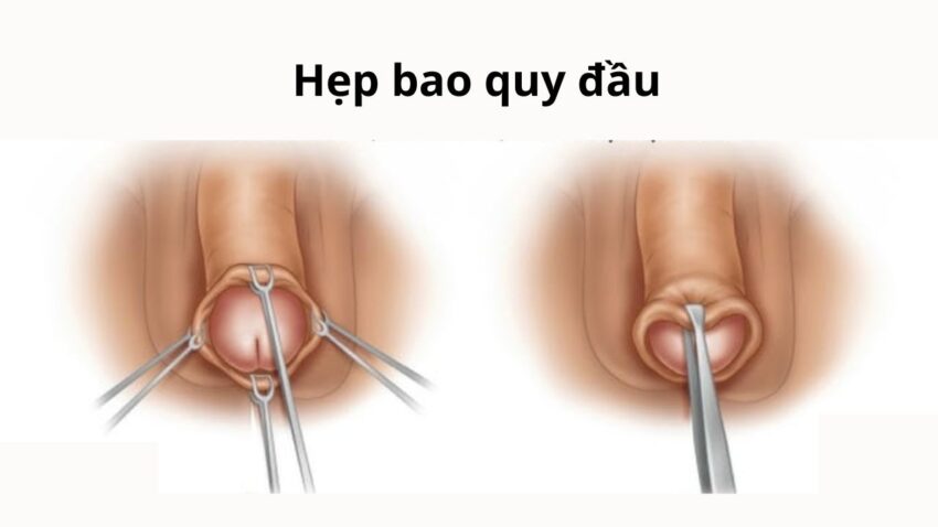 Cắt bao quy đầu sẽ làm giảm khoái cảm